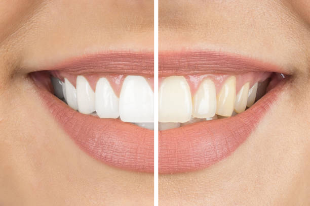 Brighten Your Smile for the Holidays: Complimentary Whitening Consultation & £100 Off Zoom Whitening at Dental Rooms!