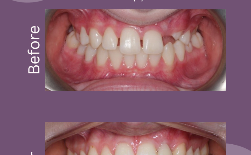 A Thoughtful Invisalign First Journey at Dental Rooms