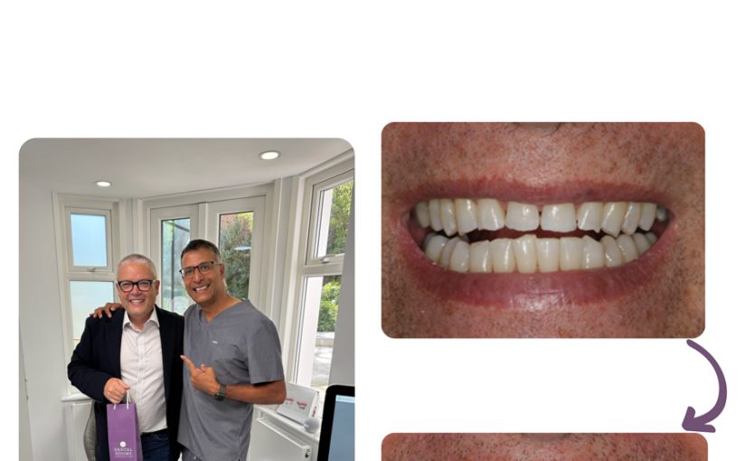 A Brighter, More Confident Smile: Michael’s Tooth Whitening and Bonding Journey at Dental Rooms, Wimbledon