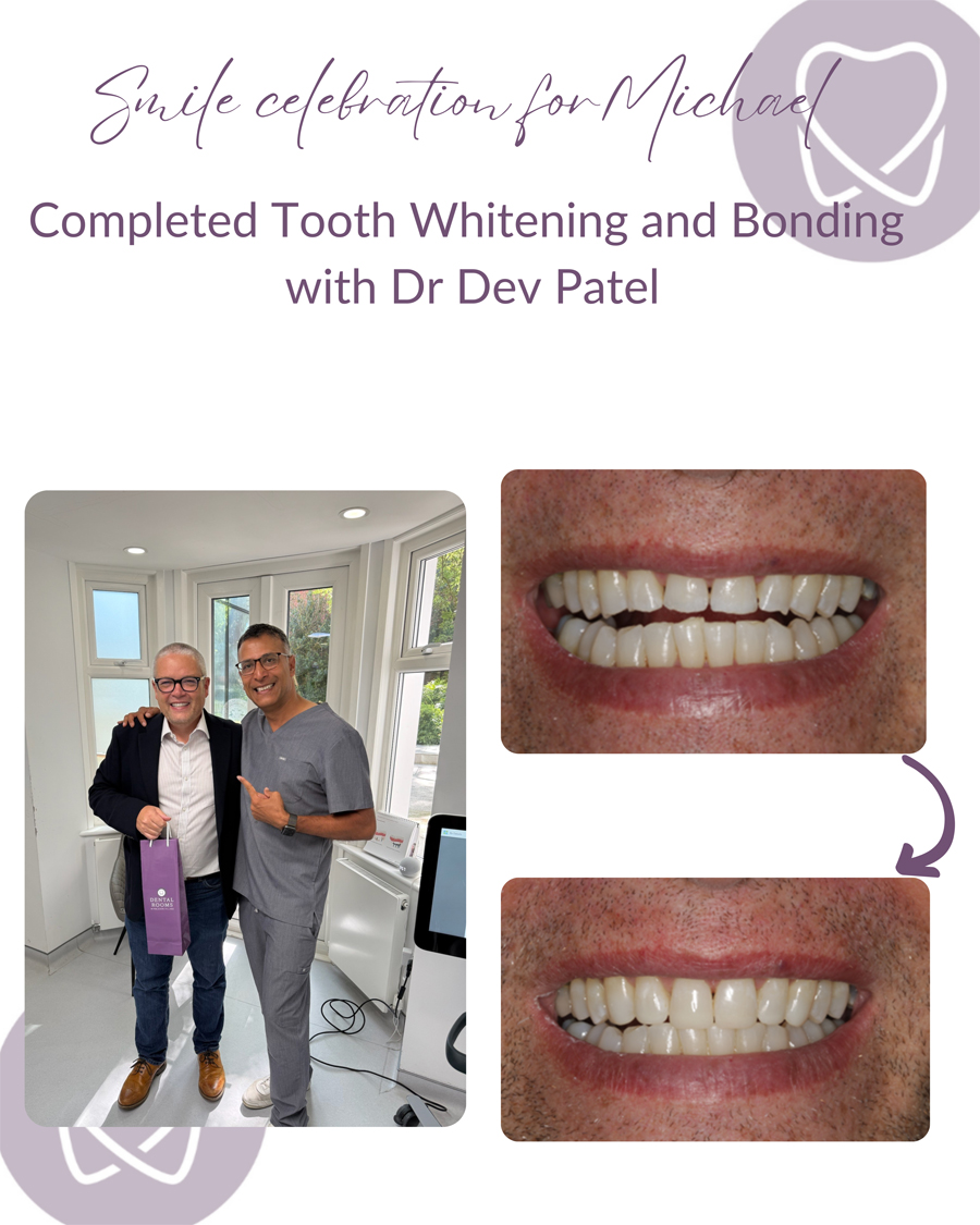 teeth-whitening-in-wimbledon