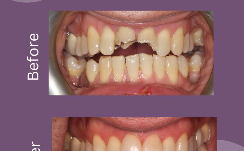 Smile Refreshed: Restoring Worn & Chipped Teeth with Injection Moulding