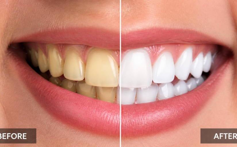 Your Summer Guide to Professional Teeth Whitening
