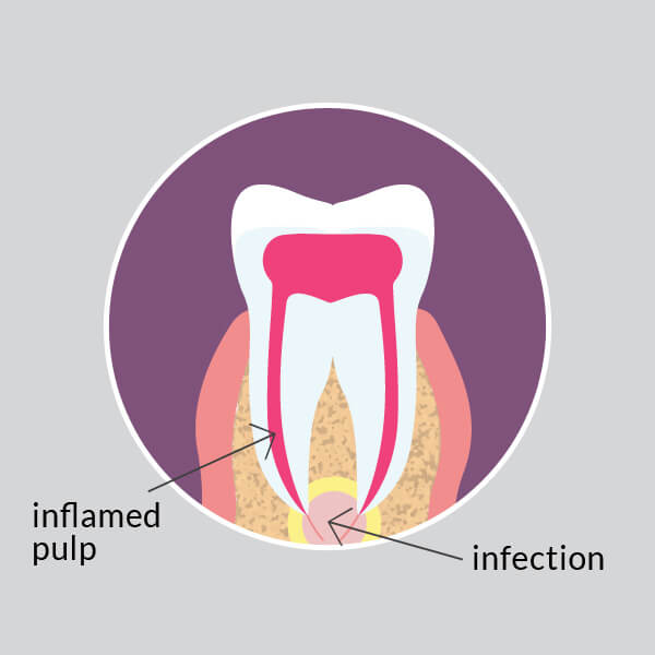 Infected Tooth