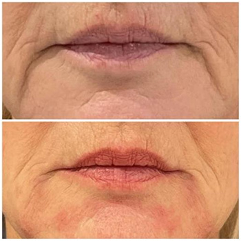 Marionette line / lowerfacerejuvenation