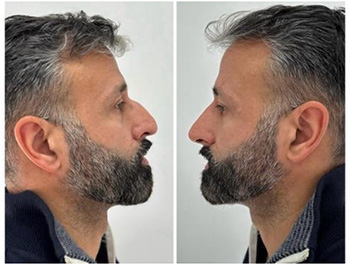 The non surgicalrhinoplasty